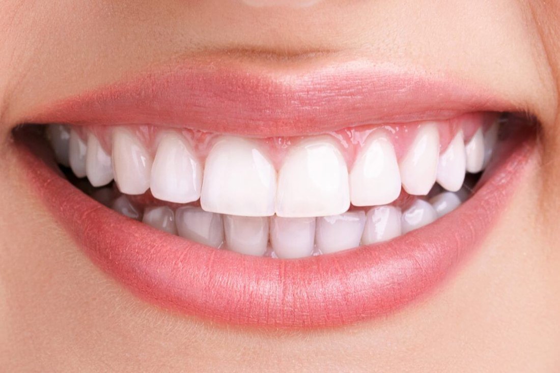 Osmijeh poslije estetskog zahvata – Dental MM Zagreb