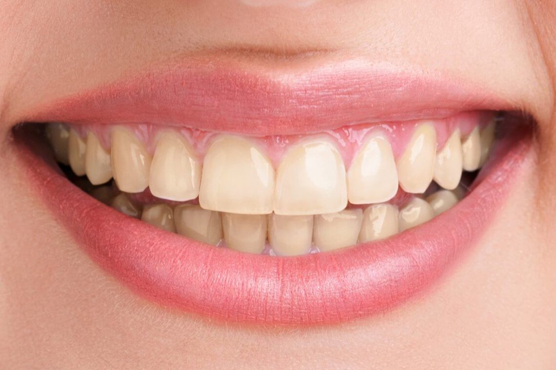 Osmijeh prije estetskog zahvata – Dental MM Zagreb